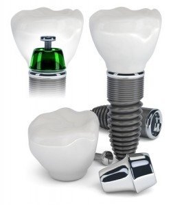 dental implants vs mini dental implants