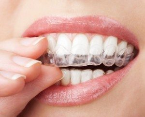 Teeth Whitening: The Great White Whale of Dental Care