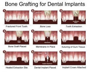 Implant - Healed extraction site