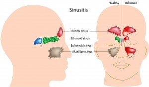 Sinus Infections Toothaches