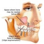 Dental Implants & Sinus Lift Surgery