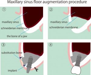 What is a sinus lift surgery and why is it necessary