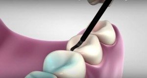 What are dental sealants?