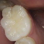 healthy tooth