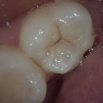 mild dental cavity