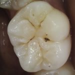 moderate dental cavity