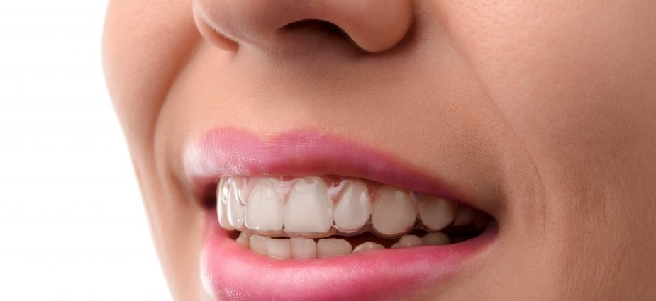 invisalign teeth aligners