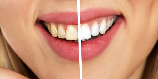 professional teeth whitening charlotte nc