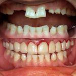 complete smile makeover