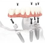 all-on-4 dental implants charlotte