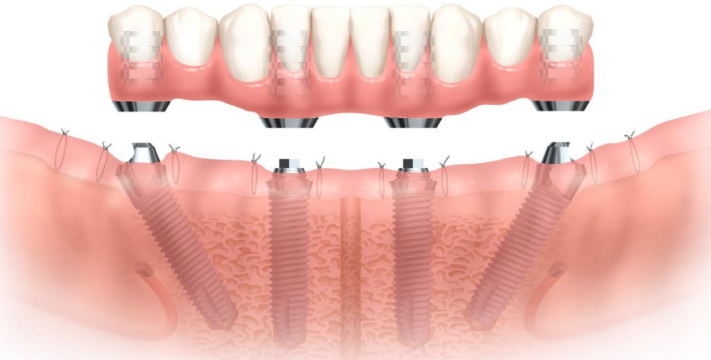 5 Benefits of All-on-4 Dental Implants