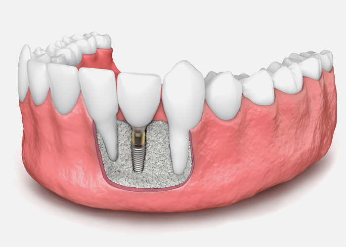 All About Bone Grafting Procedures