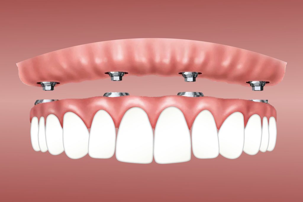 dental implant charlotte