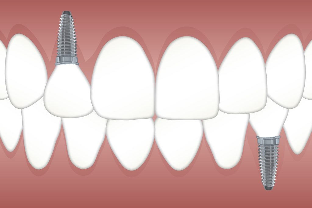 Dental Implant Solutions