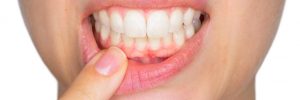 Complications of Chronic Gum Disease