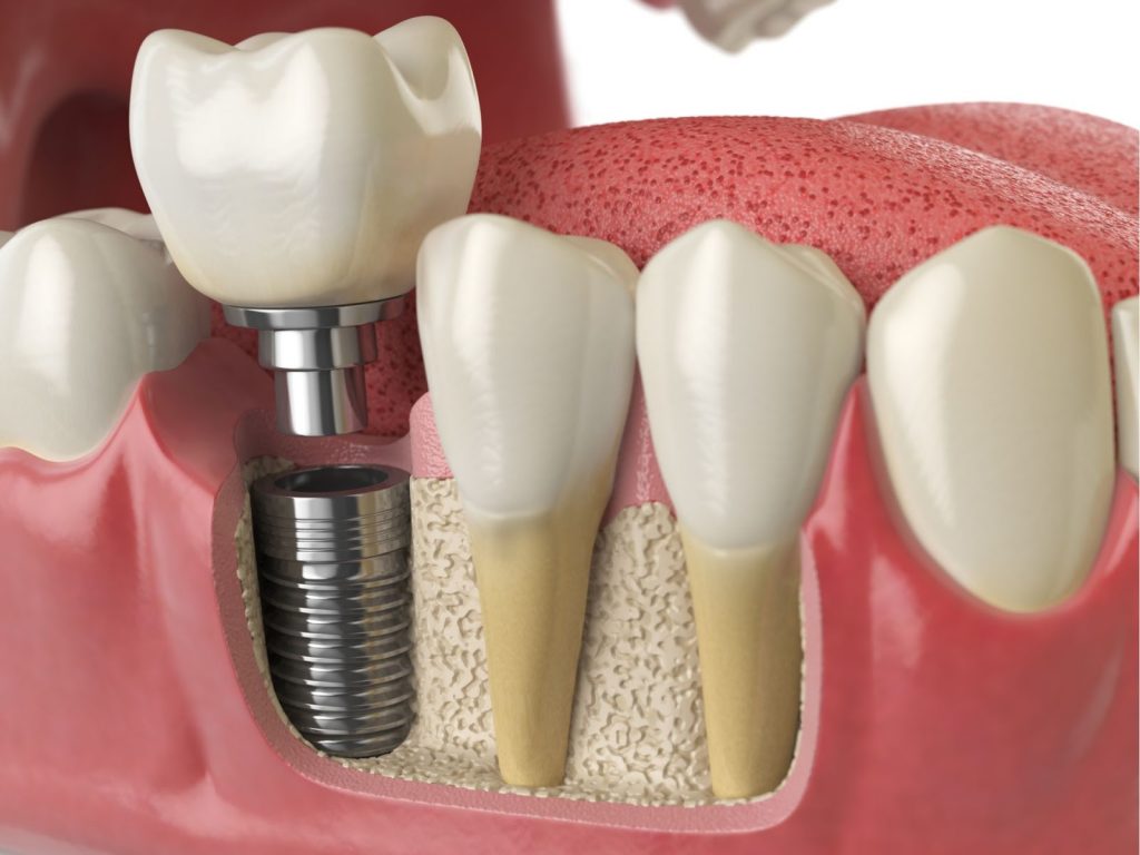 How to Know If You Need Mini Dental Implants?