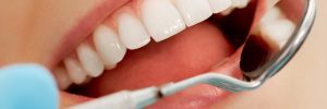 How Do Cavities Start and What Can You Do About Them