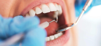 Root Canal Therapy
