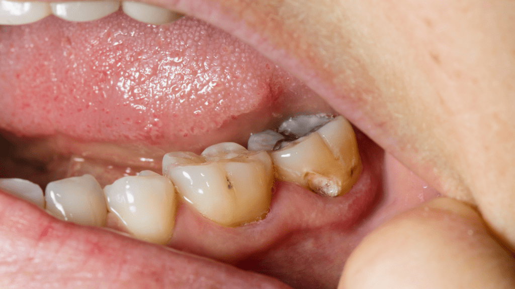 Visible holes in your tooth may indicate a cavityBlog